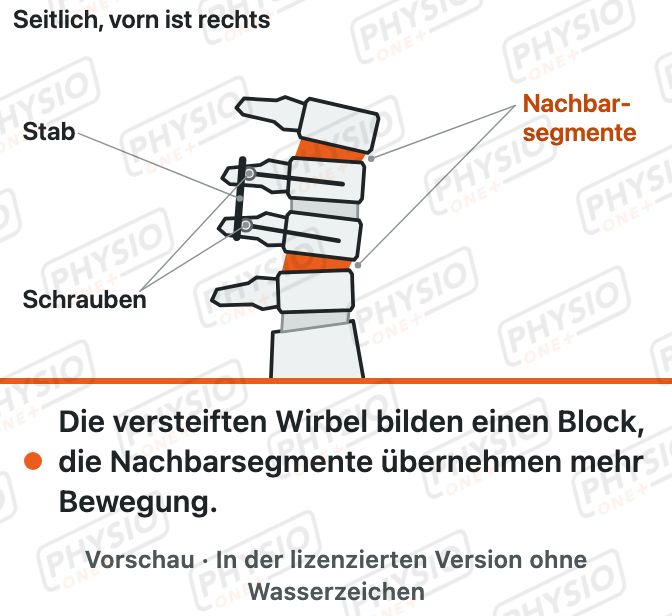 Vorschau: Versteifung der Wirbelsäule (Spondylodese)