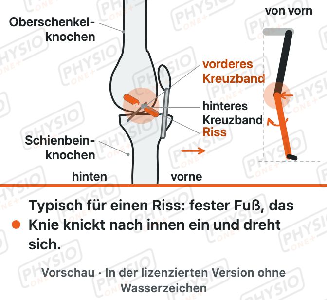 Vorschau: Vorderes Kreuzband