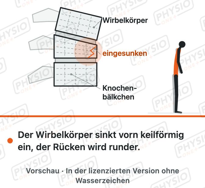 Vorschau: Wirbelbruch bei Osteoporose